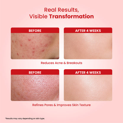 Resurfacing Serum 5% AHA + 2% BHA (30ml)